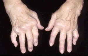 arthritis